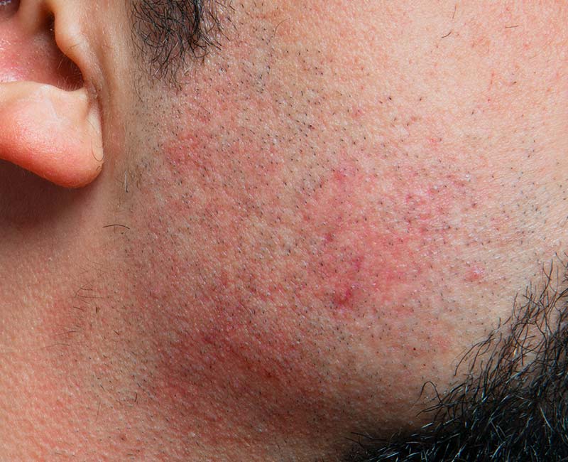 Homem com a pele da cara irritada por causa de irritação ao barbear.
